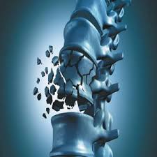 Cost effectiveness analysis of fracture liaison services in Iran